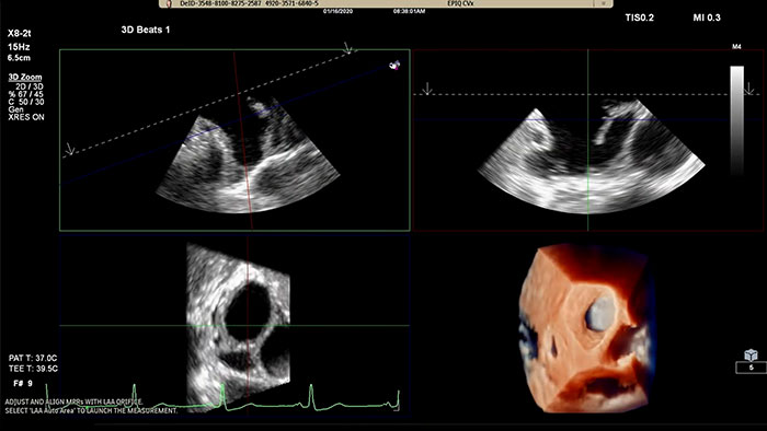 Die Philips L&ouml;sung zur Diagnose des linken Vorhofohrs auf dem EPIQ CVx