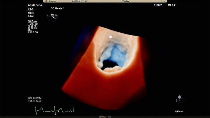 Philips Cardiac TrueVue auf dem EPIQ&nbsp;CVx.