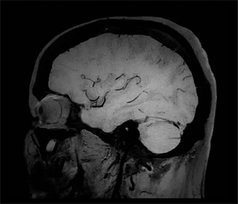 Black-Blood-Bildgebung f&uuml;r h&ouml;here Diagnosesicherheit bei der Bildgebung des Gehirns​